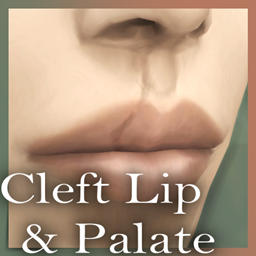 Cleft Lip and Palate Scar Born Defect project image